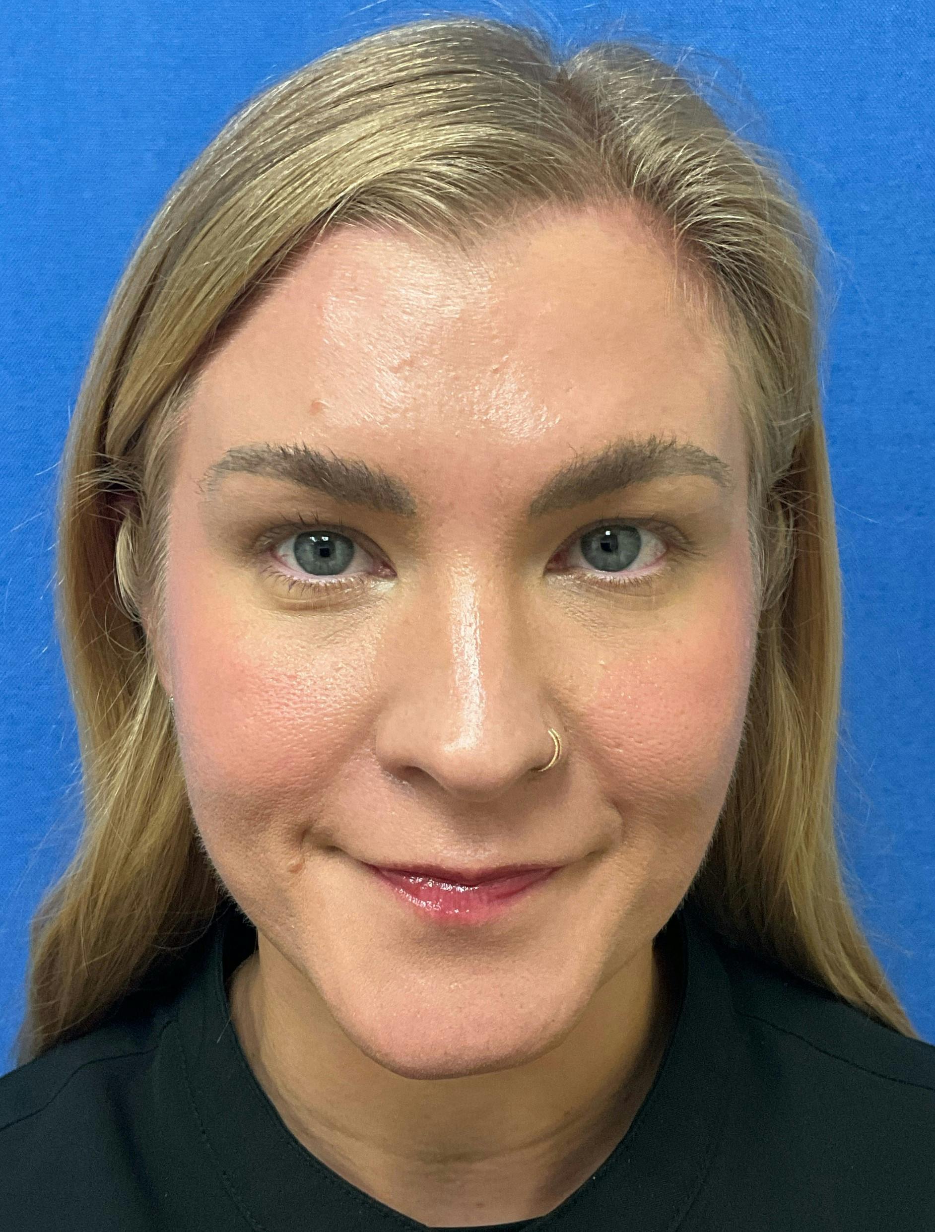 Katelyn Oldenburg, PA-C Before & After Gallery - Patient 169353 - Image 2