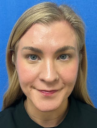 Katelyn Oldenburg, PA-C Before & After Gallery - Patient 169353 - Image 2