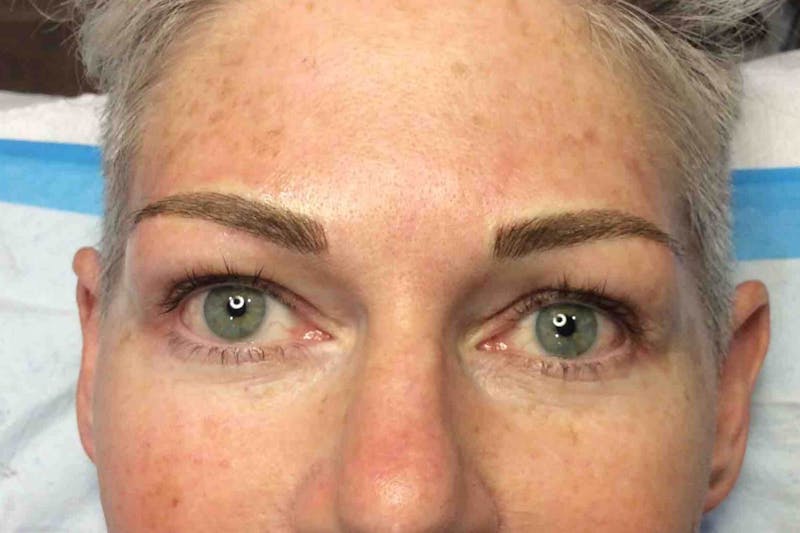 Alison Kuzoian Before & After Gallery - Patient 354752 - Image 2