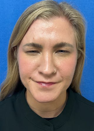 Katelyn Oldenburg, PA-C Before & After Gallery - Patient 169353 - Image 4