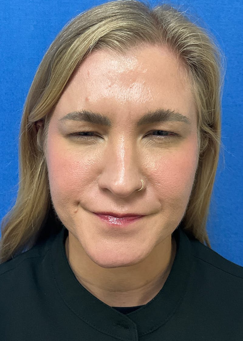 Katelyn Oldenburg, PA-C Before & After Gallery - Patient 169353 - Image 4