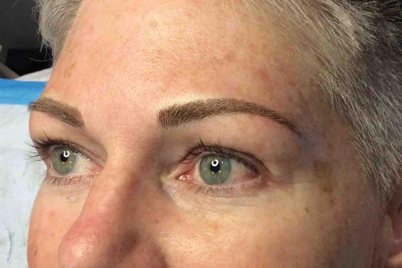 Alison Kuzoian Before & After Gallery - Patient 354752 - Image 4