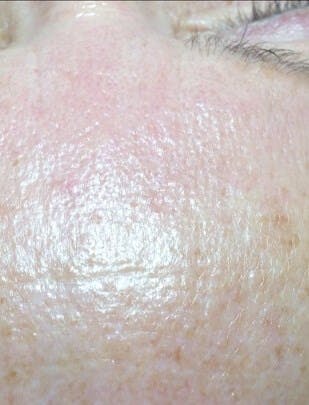 Kim Lindsey Before & After Gallery - Patient 424115 - Image 2