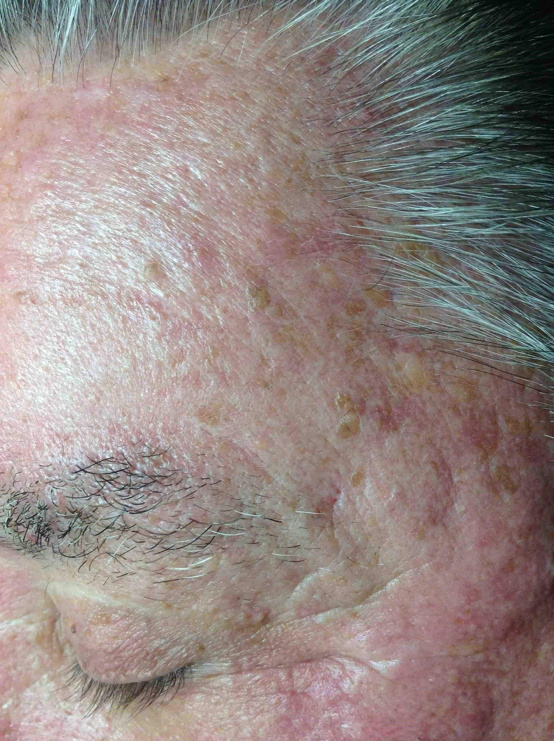 Kim Lindsey Before & After Gallery - Patient 114754 - Image 1