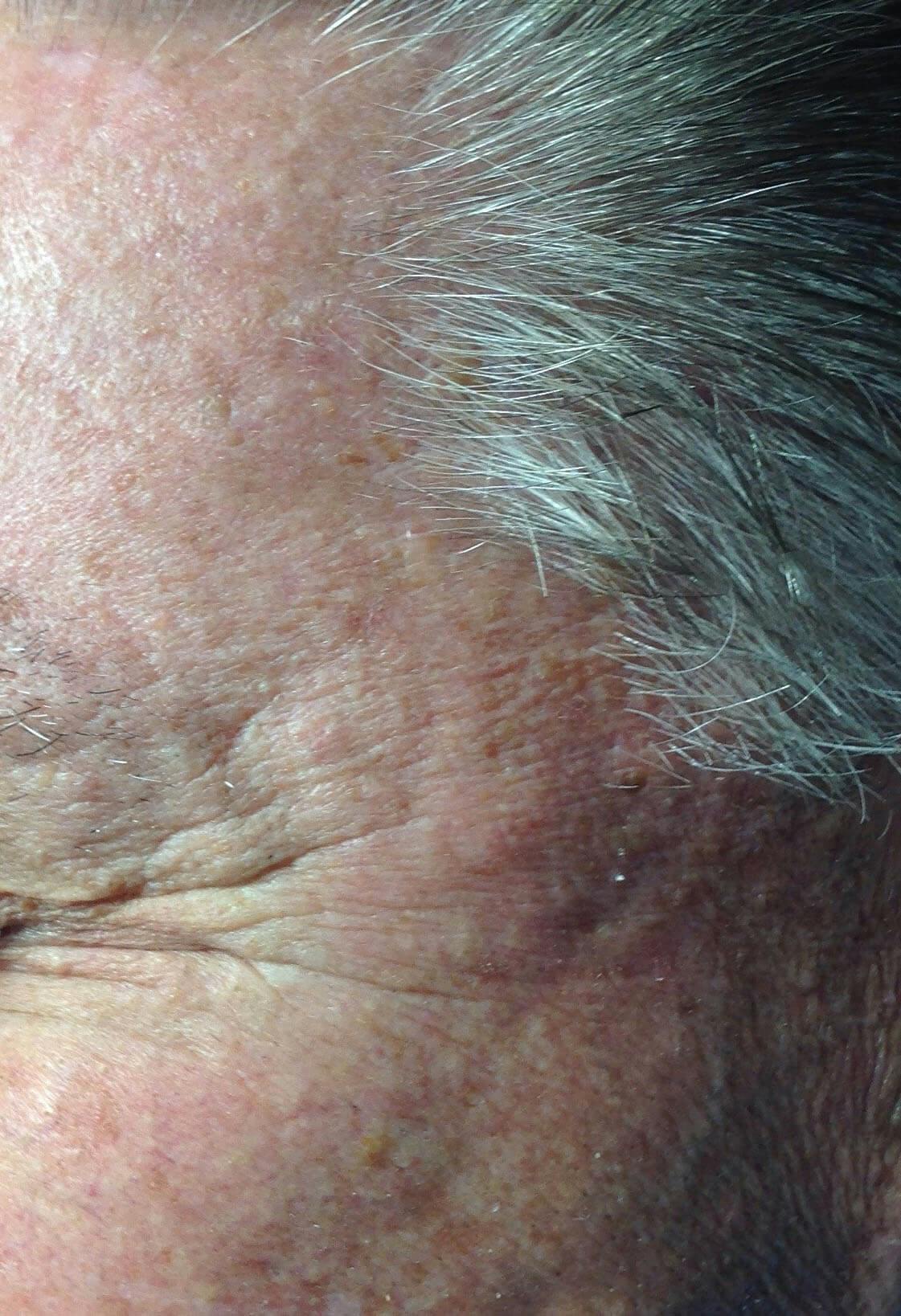Kim Lindsey Before & After Gallery - Patient 114754 - Image 2