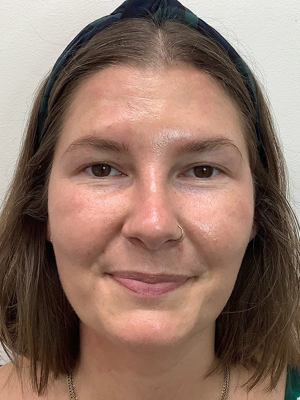 Kylene Globis Before & After Gallery - Patient 150298 - Image 2