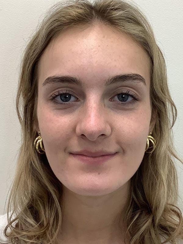 Kylene Globis Before & After Gallery - Patient 174644 - Image 1