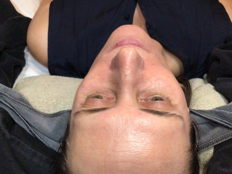 Kim Lindsey Before & After Gallery - Patient 555361 - Image 2