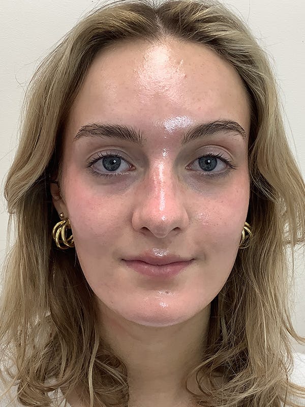 Kylene Globis Before & After Gallery - Patient 174644 - Image 2