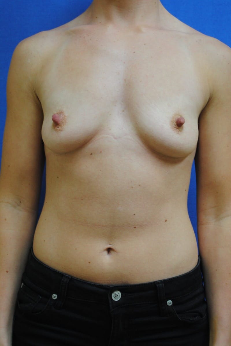 Dr. Robert Burk Before & After Gallery - Patient 297517 - Image 1