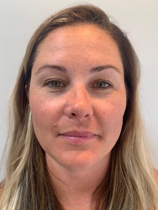 Kylene Globis Before & After Gallery - Patient 197072 - Image 1