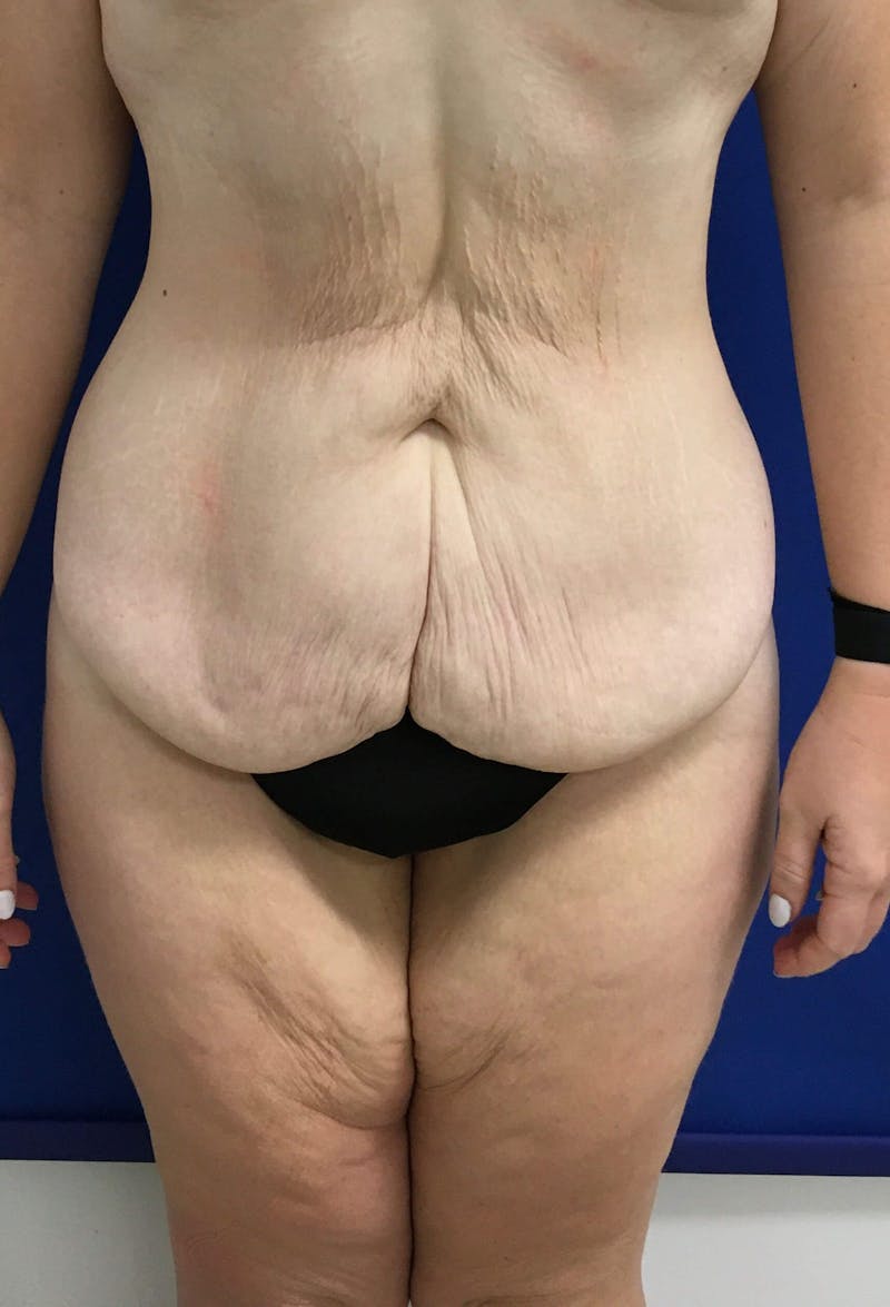 After Weight Loss Surgery Before & After Gallery - Patient 357768 - Image 1