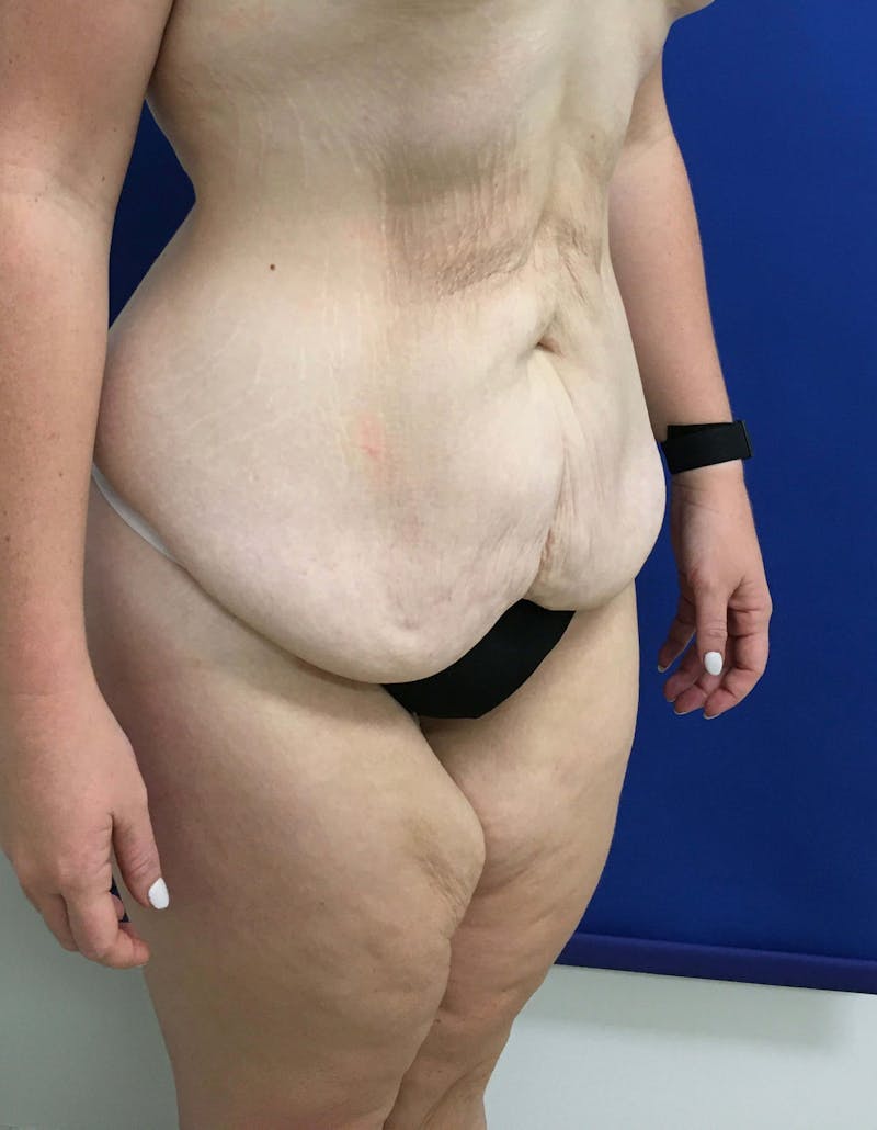 After Weight Loss Surgery Before & After Gallery - Patient 357768 - Image 3
