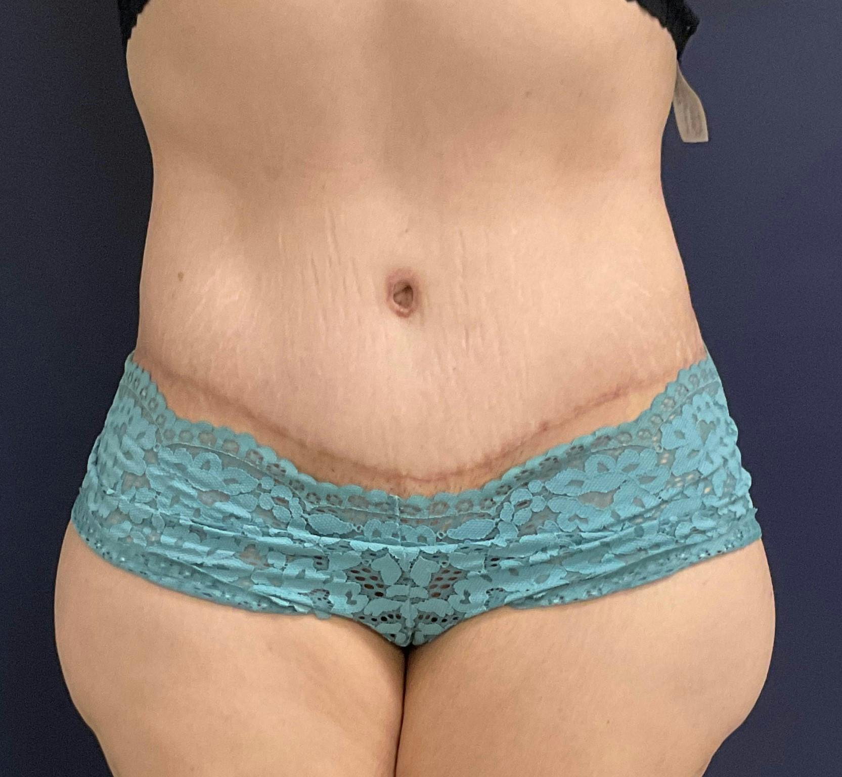 Tummy Tuck Before & After Gallery - Patient 260429 - Image 2