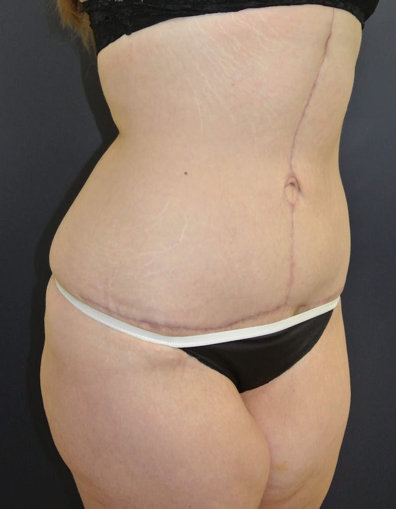 After Weight Loss Surgery Before & After Gallery - Patient 357768 - Image 4