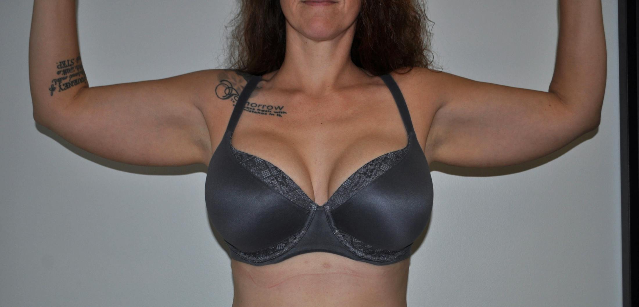 Arm Lift (Brachioplasty) Before & After Gallery - Patient 132756 - Image 1
