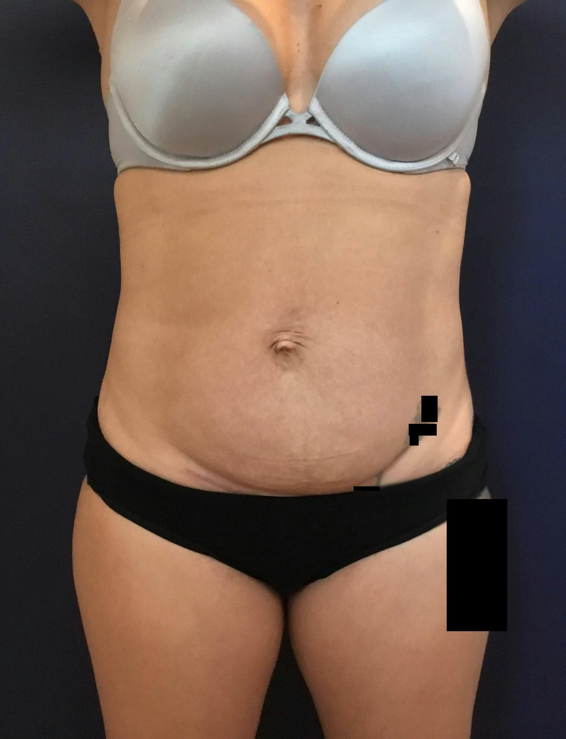 Tummy Tuck Before & After Gallery - Patient 301184 - Image 1