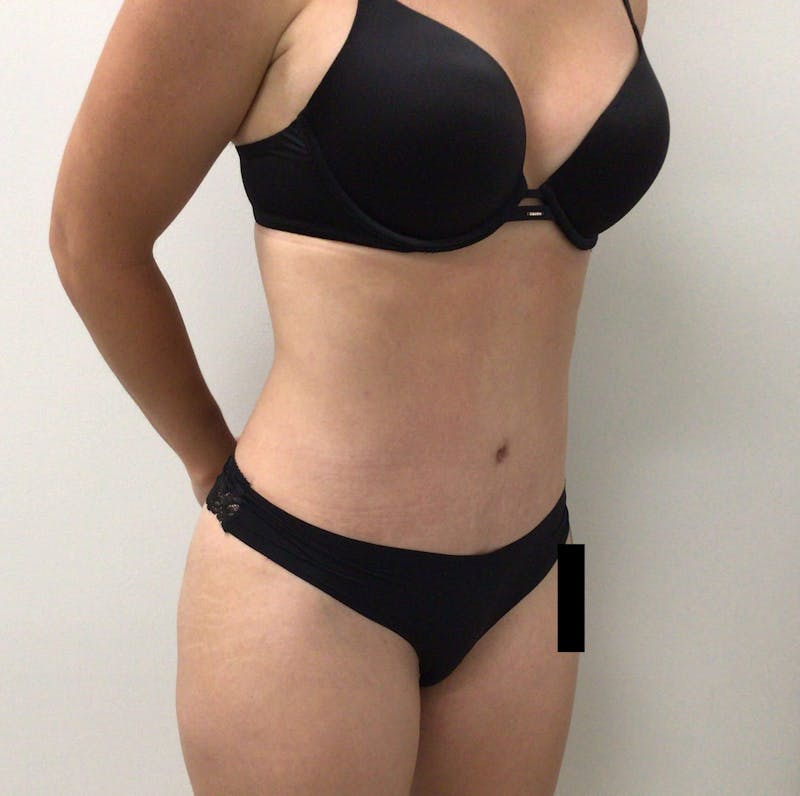 Tummy Tuck Before & After Gallery - Patient 301184 - Image 4