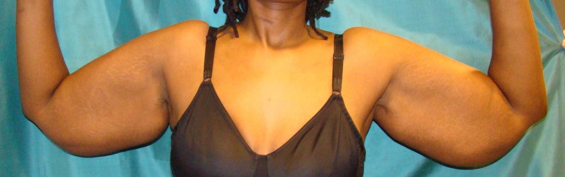 Arm Lift (Brachioplasty) Before & After Gallery - Patient 301024 - Image 1