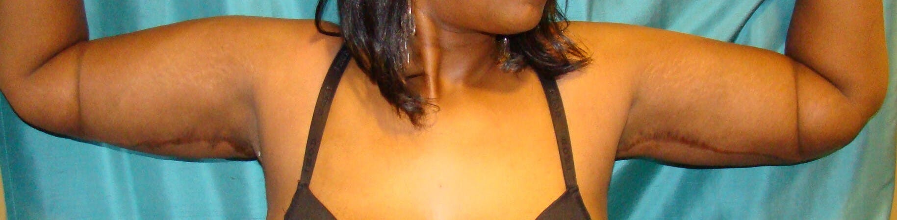 Arm Lift (Brachioplasty) Before & After Gallery - Patient 301024 - Image 2