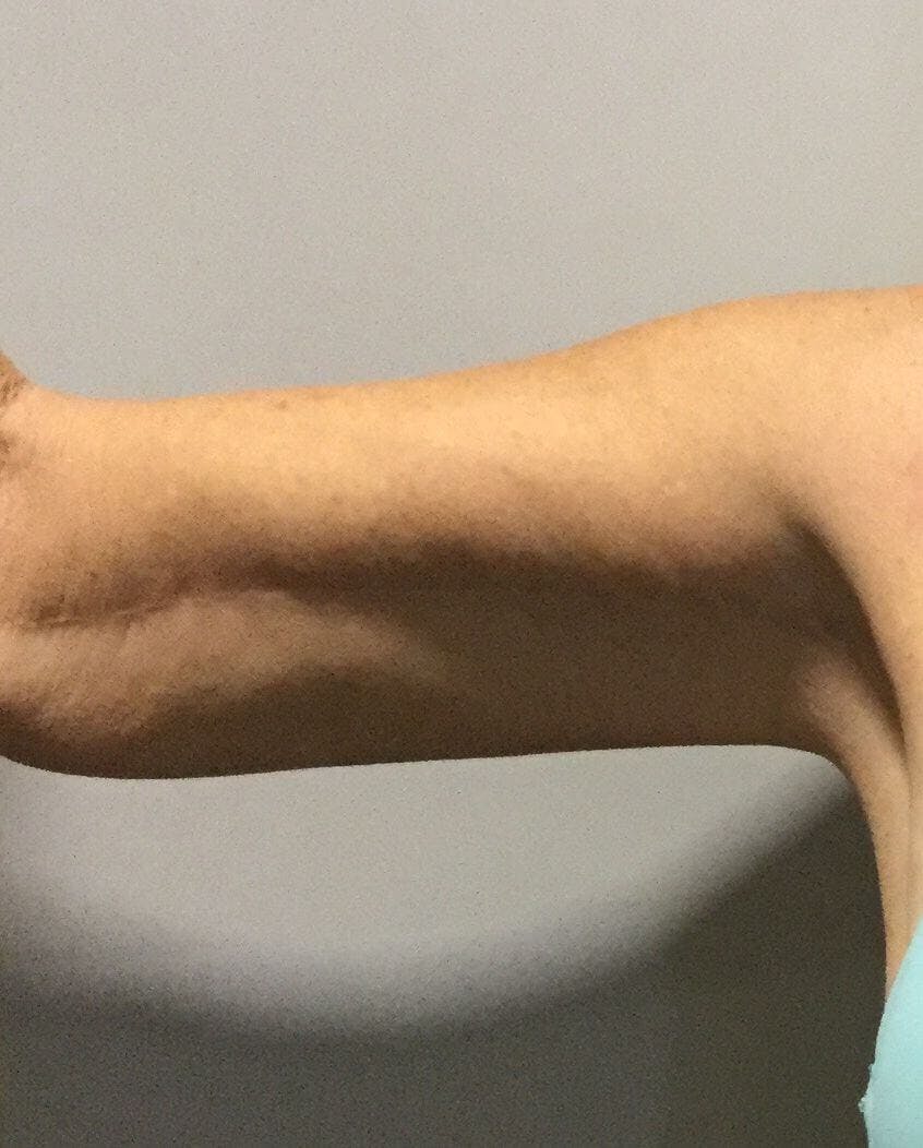 Arm Lift (Brachioplasty) Before & After Gallery - Patient 292155 - Image 2