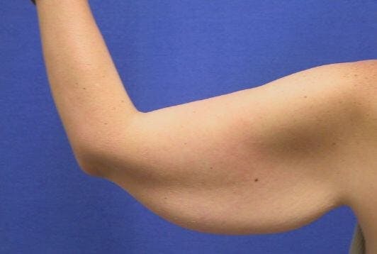 Arm Lift (Brachioplasty) Before & After Gallery - Patient 496366 - Image 1