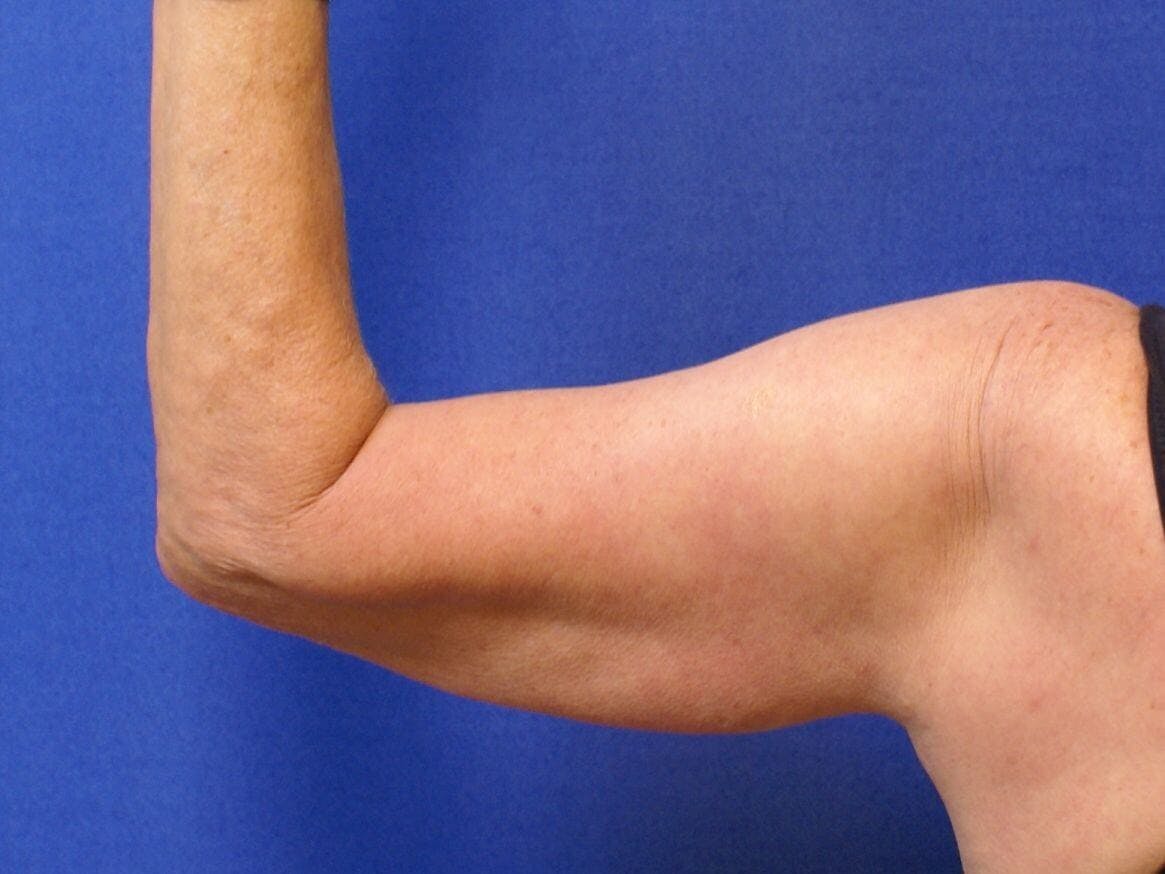 Arm Lift (Brachioplasty) Before & After Gallery - Patient 615780 - Image 1