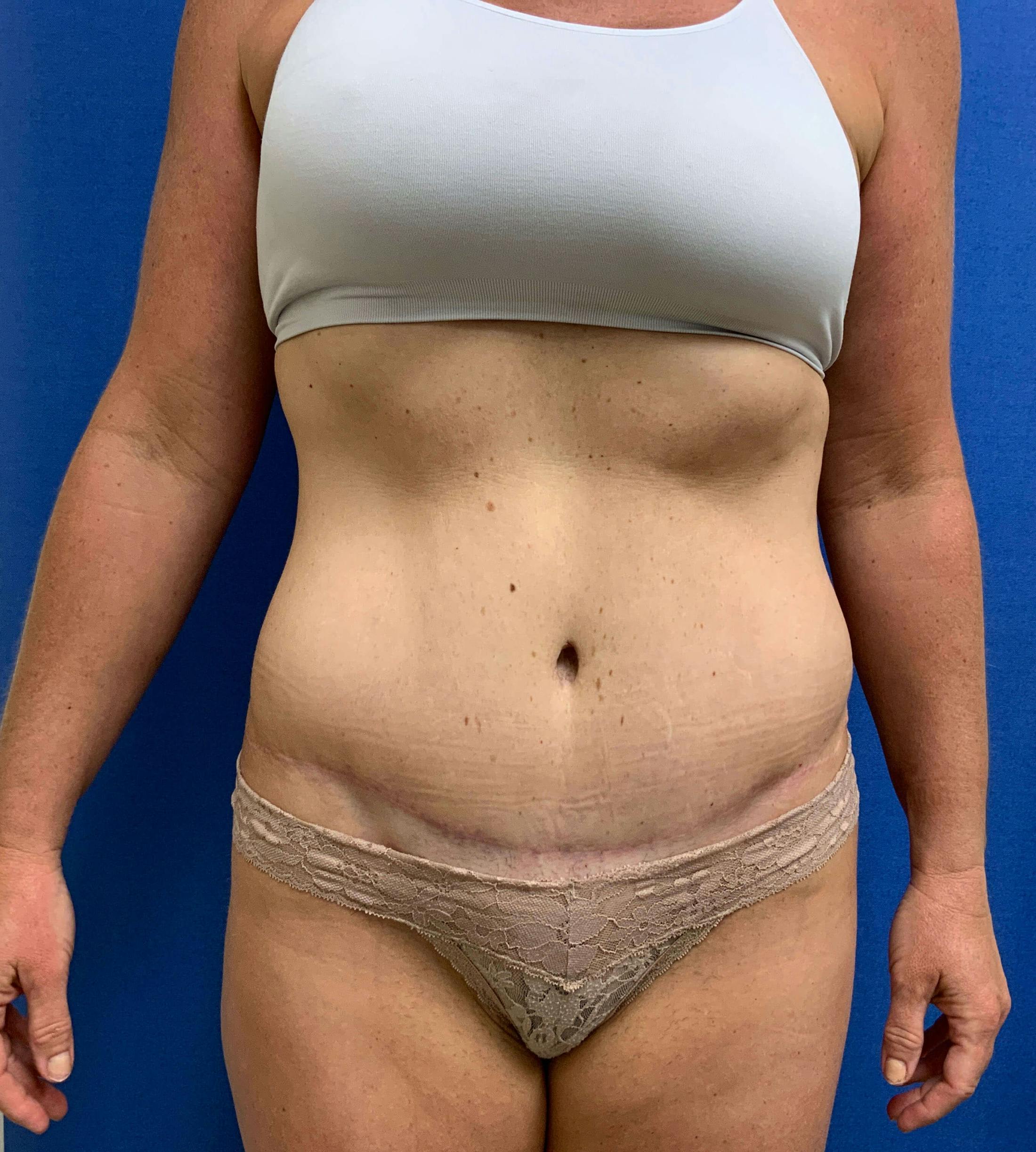 Tummy Tuck Before & After Gallery - Patient 736534 - Image 2