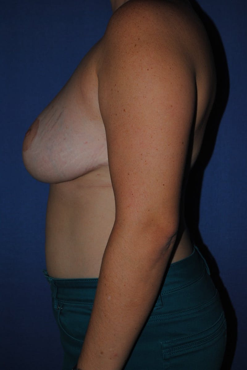 Dr. Robert Burk Before & After Gallery - Patient 603634 - Image 6
