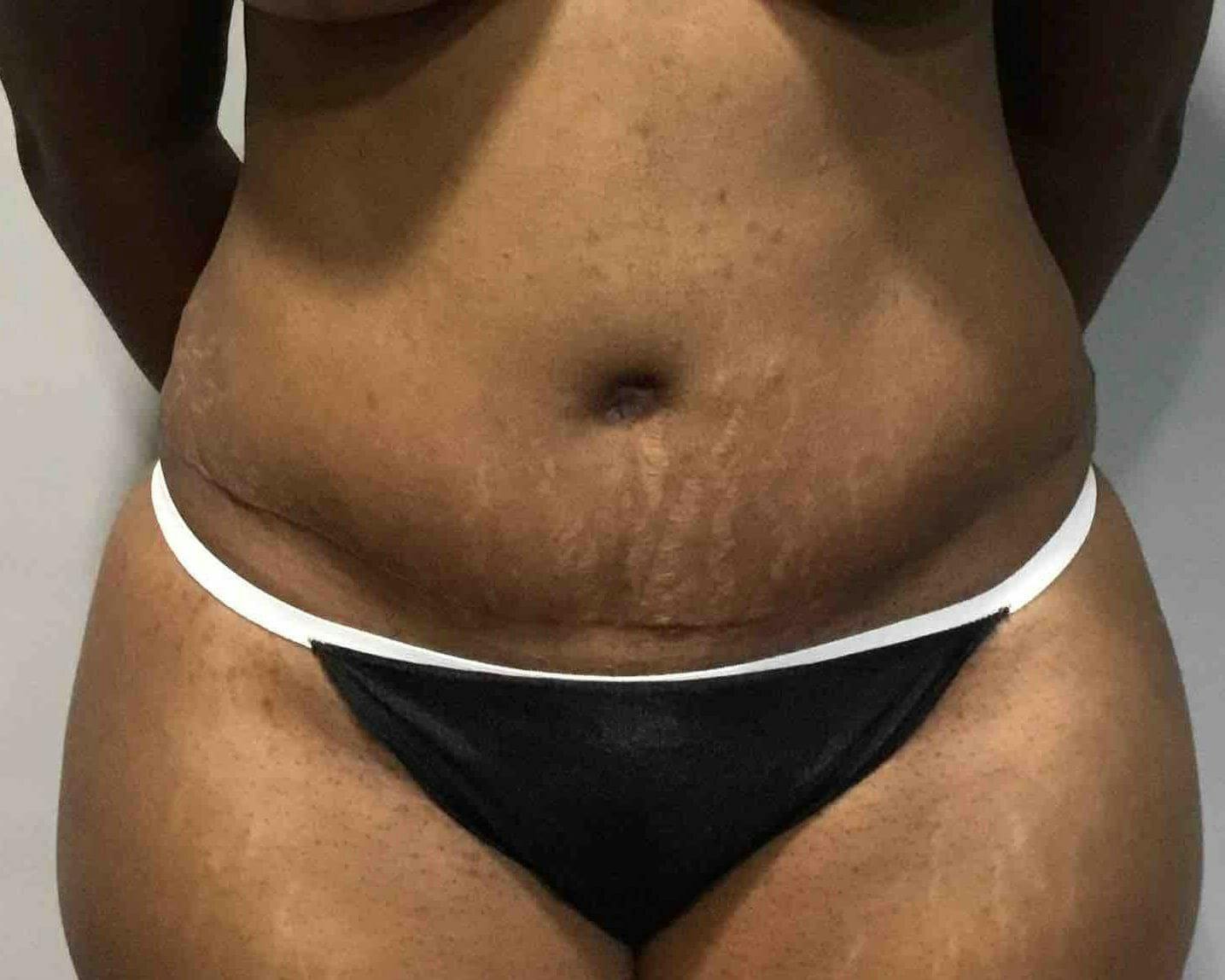 Tummy Tuck Before & After Gallery - Patient 187647 - Image 2