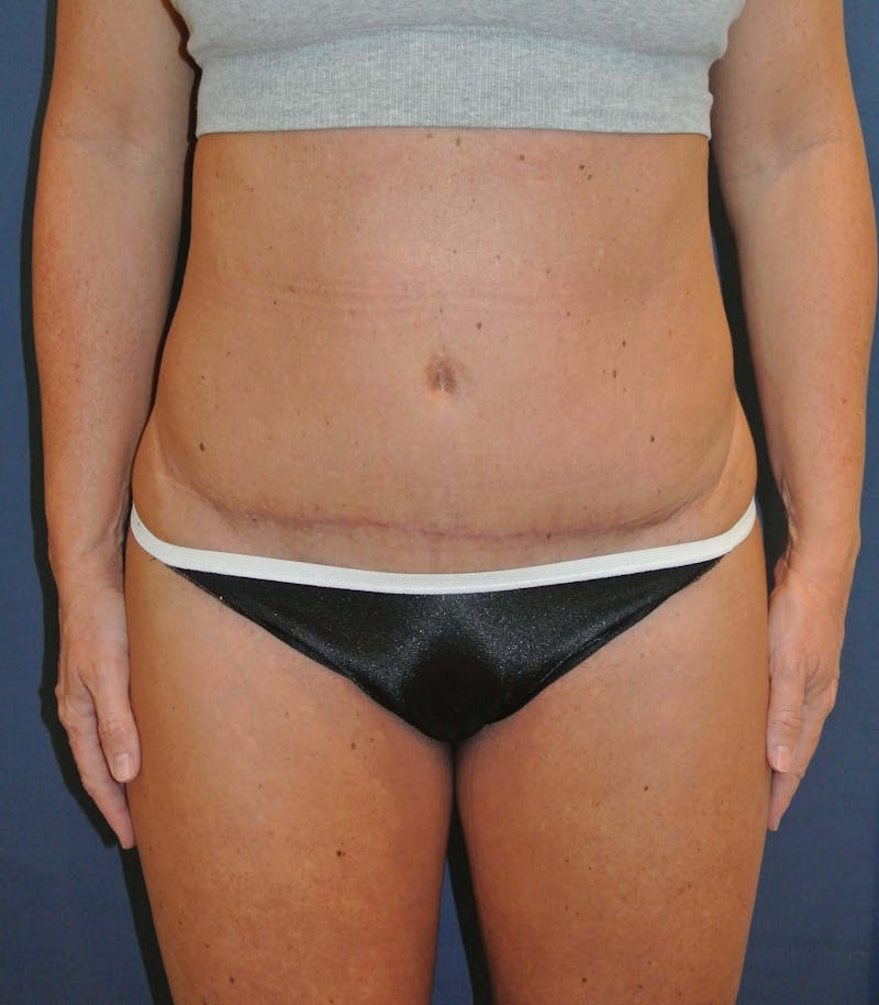 Scar Revision Before & After Gallery - Patient 187860 - Image 2