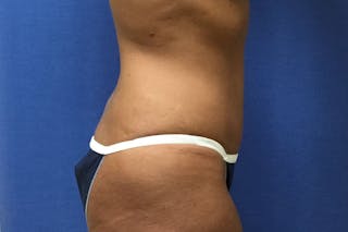 Tummy Tuck Before & After Gallery - Patient 358333 - Image 2