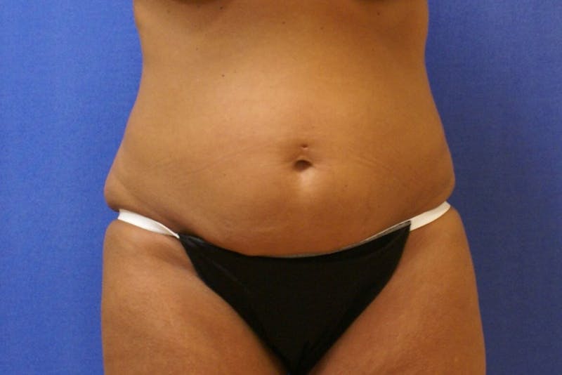 Tummy Tuck Before & After Gallery - Patient 358333 - Image 3