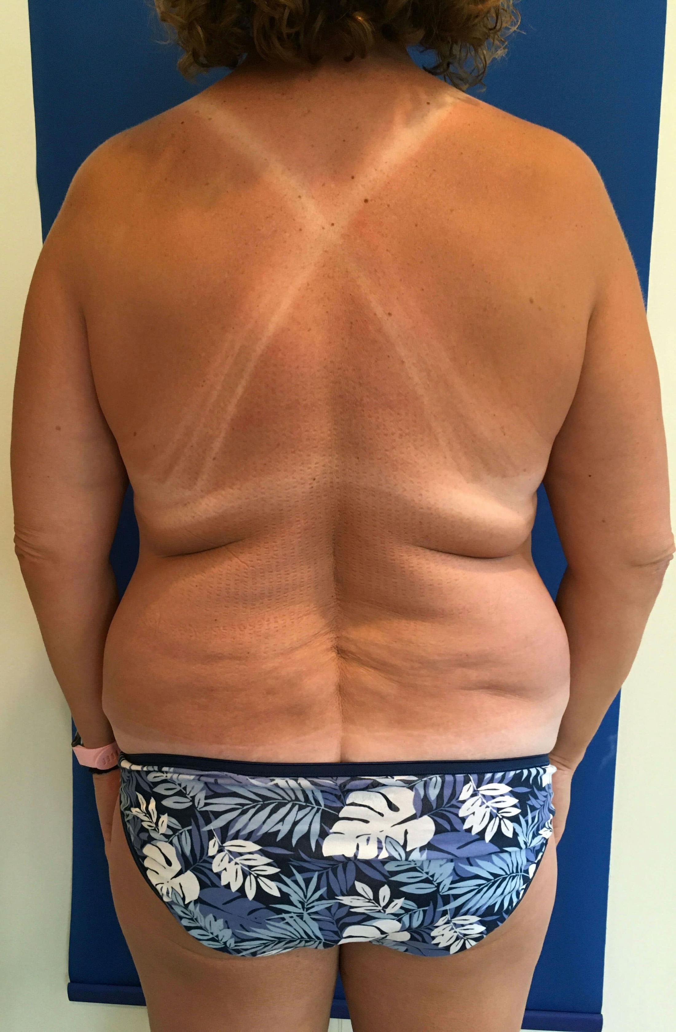 Liposuction Before & After Gallery - Patient 202941 - Image 1
