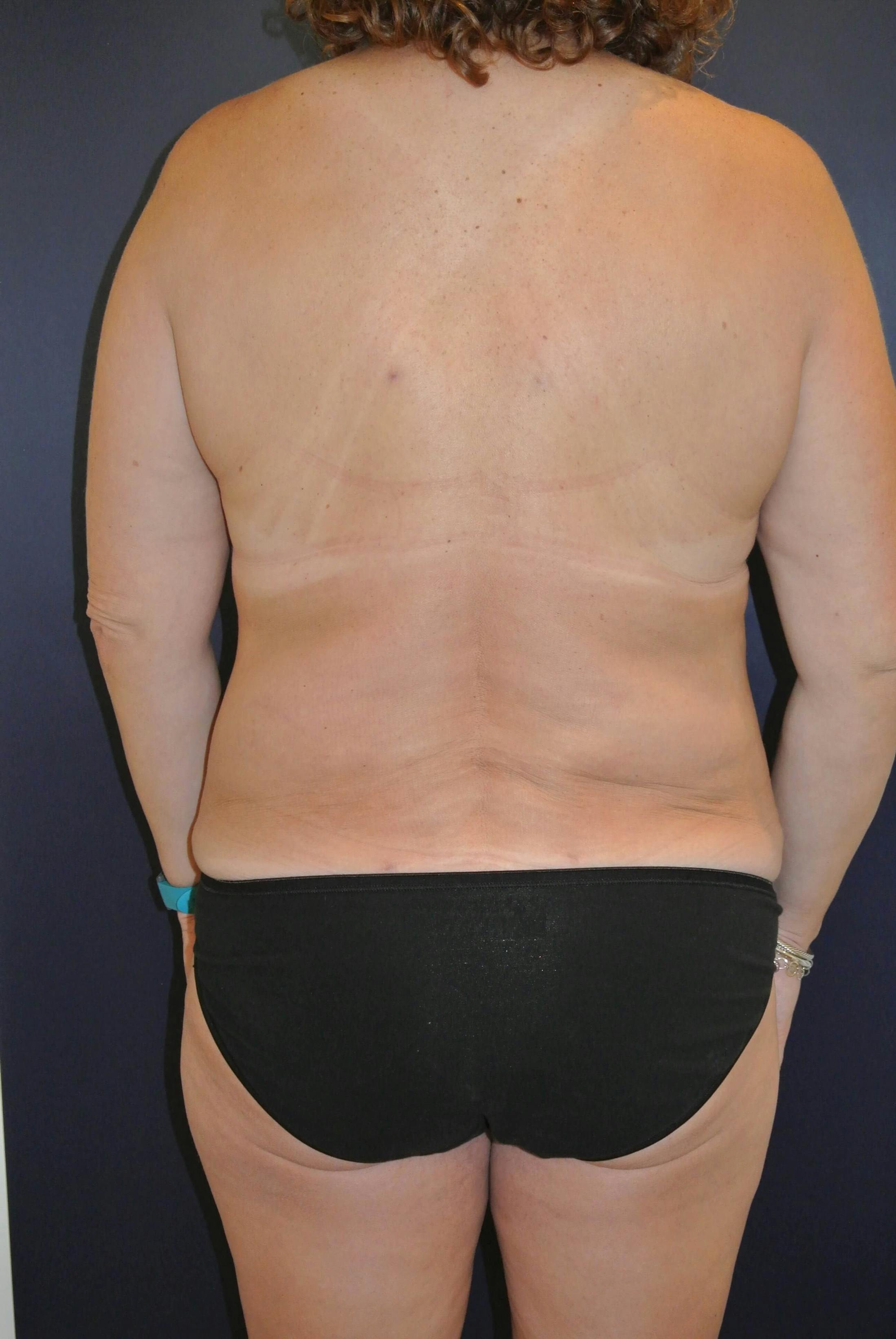 Liposuction Before & After Gallery - Patient 202941 - Image 2