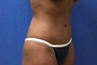 Tummy Tuck Before & After Gallery - Patient 358333 - Image 6