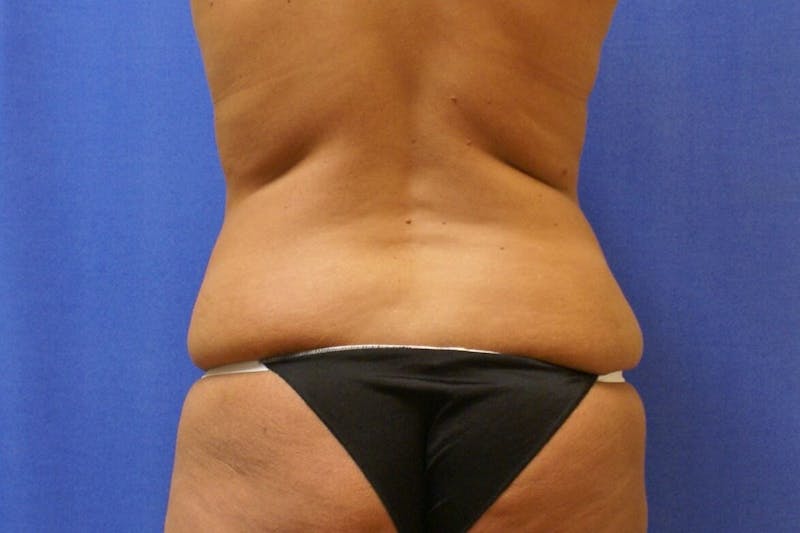 Tummy Tuck Before & After Gallery - Patient 358333 - Image 7