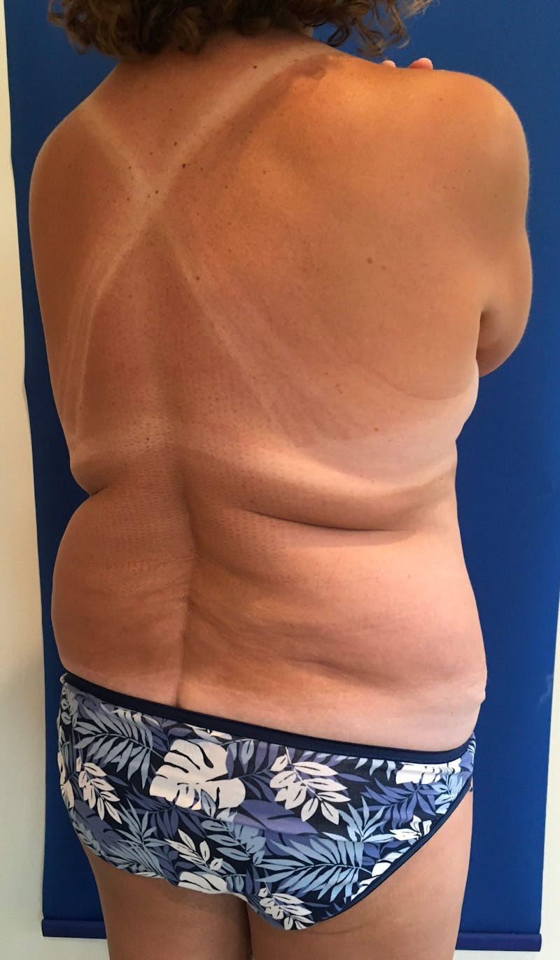 Liposuction Before & After Gallery - Patient 202941 - Image 3