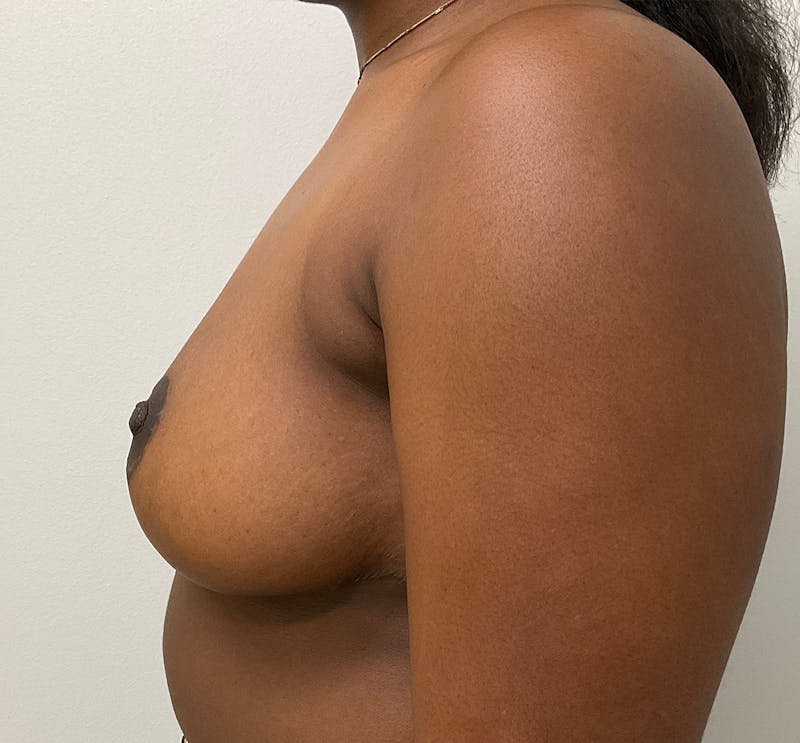 Dr. Chris Bates Before & After Gallery - Patient 133611 - Image 6