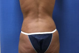 Tummy Tuck Before & After Gallery - Patient 358333 - Image 8