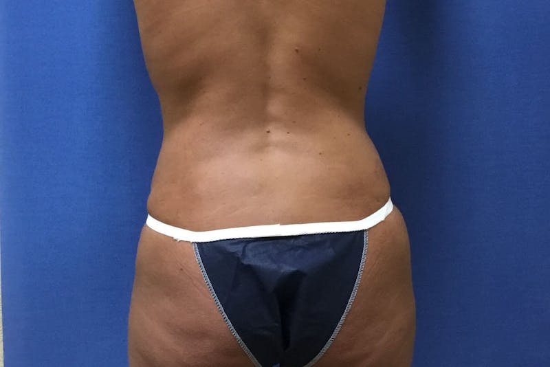 Tummy Tuck Before & After Gallery - Patient 358333 - Image 8