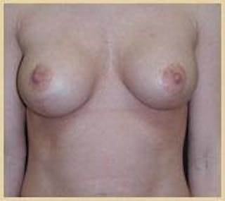 Dr. Robert Burk Before & After Gallery - Patient 403875 - Image 2
