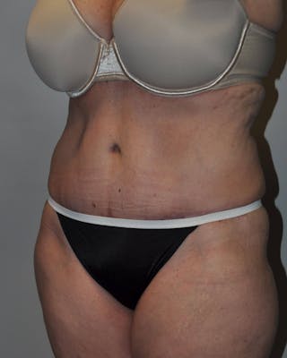 Tummy Tuck Before & After Gallery - Patient 755908 - Image 4