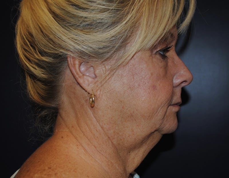 Dr. Robert Burk Before & After Gallery - Patient 107256 - Image 5