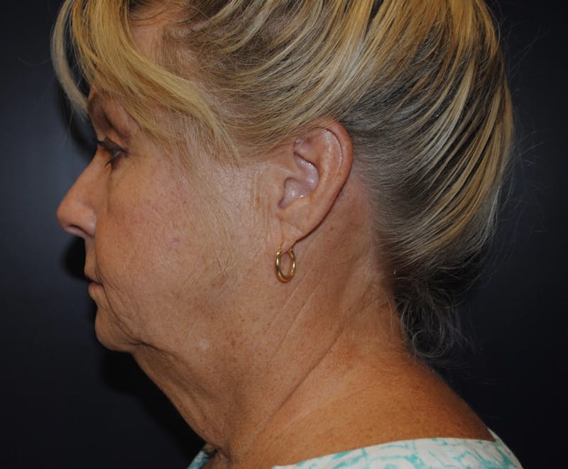 Dr. Robert Burk Before & After Gallery - Patient 107256 - Image 9