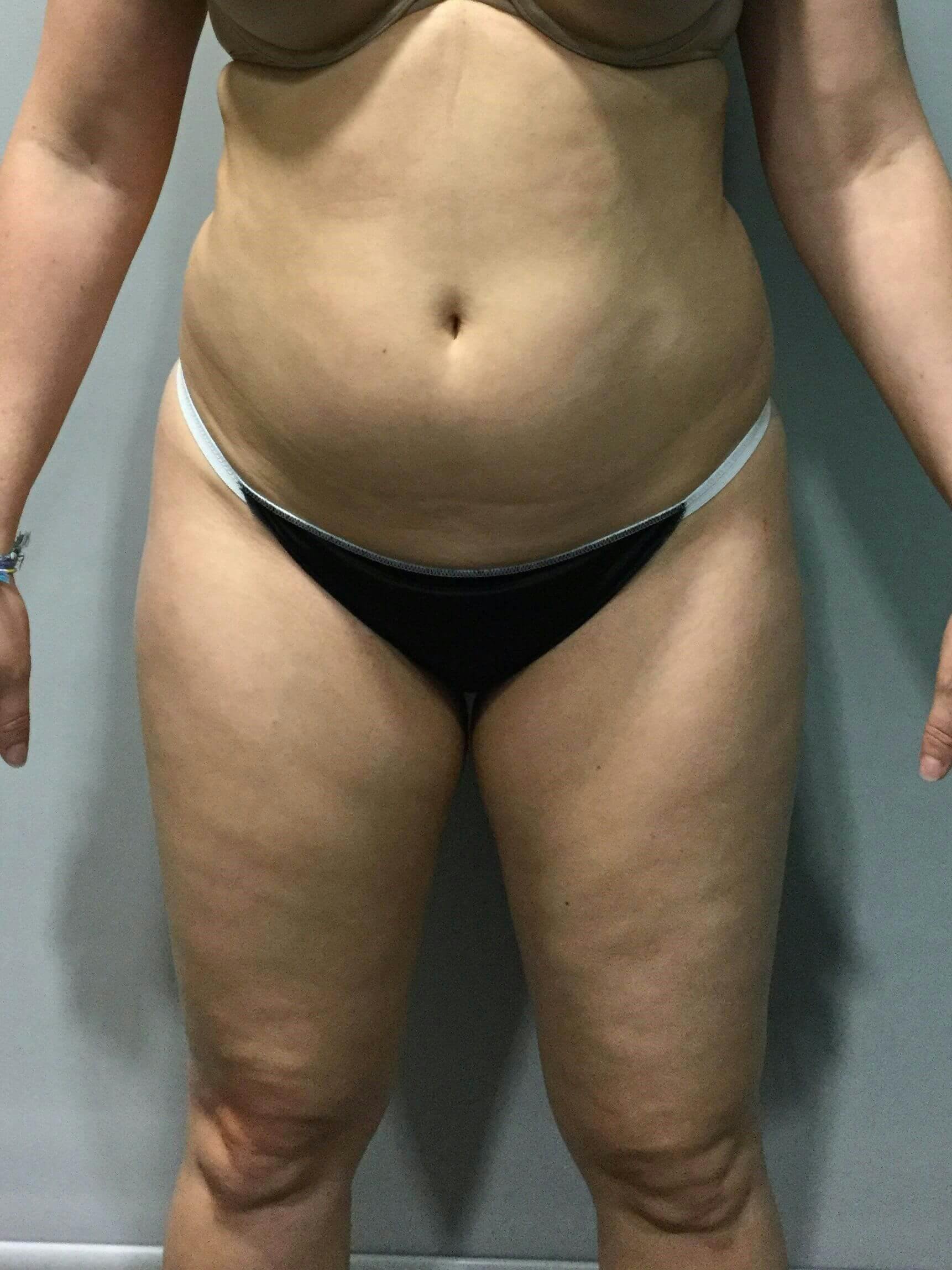 Liposuction Before & After Gallery - Patient 823152 - Image 1