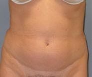 Liposuction Before & After Gallery - Patient 254194 - Image 1