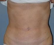 Liposuction Before & After Gallery - Patient 254194 - Image 2