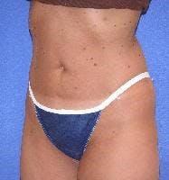 Liposuction Before & After Gallery - Patient 283584 - Image 2