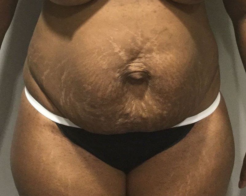 Mommy Makeover Before & After Gallery - Patient 159958 - Image 1